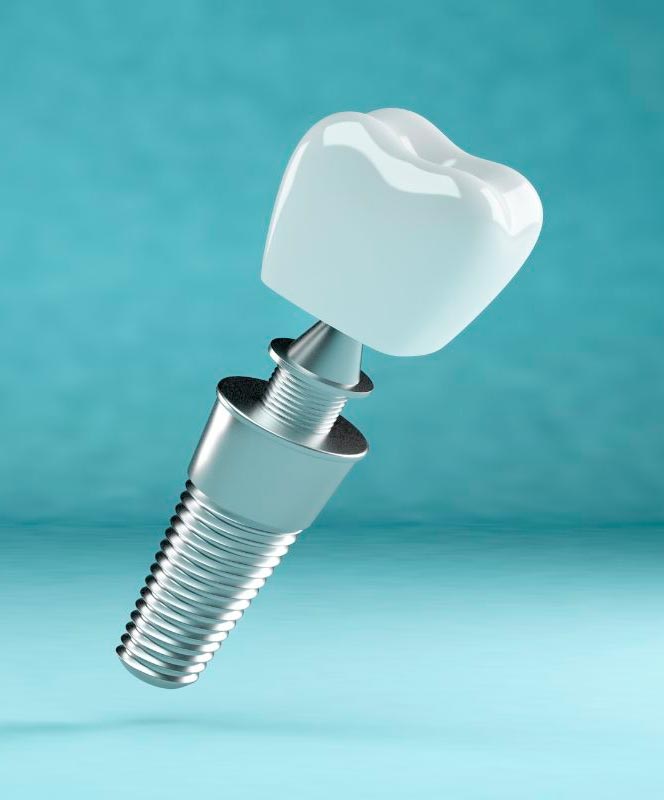 Implantes Dentales en Mallorca​