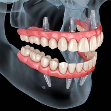 Procedimiento All On Four Mallorca