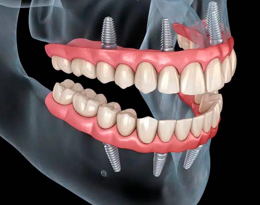 Procedimiento All On Four Mallorca